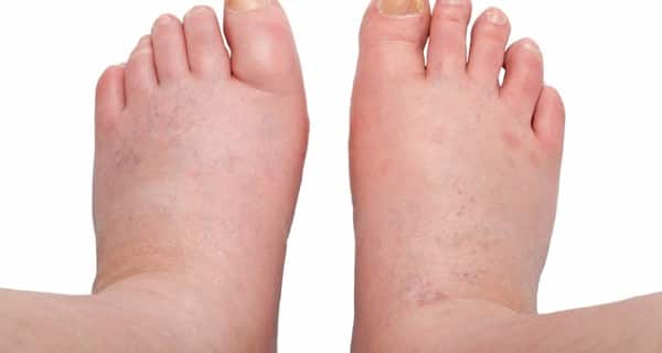 Soothing home remedies for swollen feet