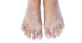 Here are 5 things you should know about Hand Foot and Mouth Disease
