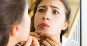 Popped that pimple? Now here's how to prevent acne scars
