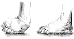 Clubfoot surgery helped a little girl take her first steps