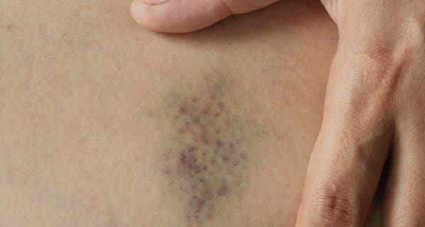 Red or purple spots the skin -- it indicate? |