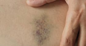 Red or purple spots on the skin -- what does it indicate? Red or purple spots on the skin -- what does it indicate?