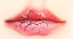 7 tips for treating chapped lips that work
