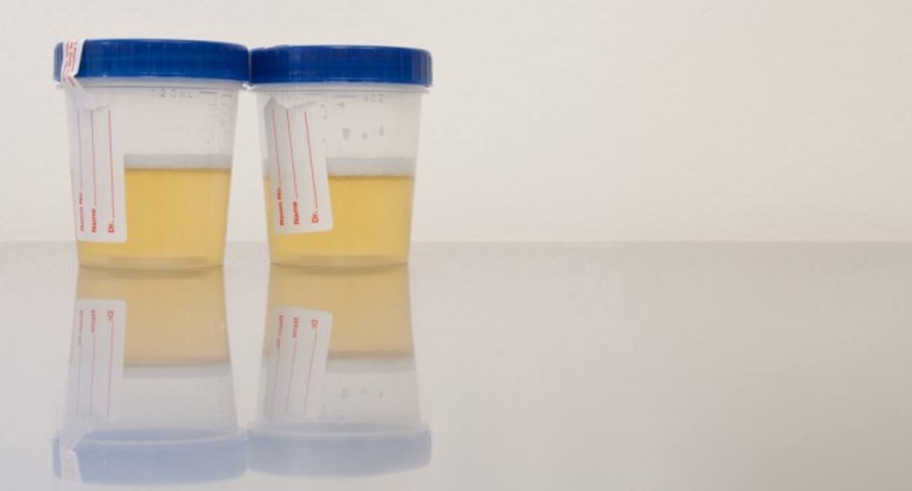 10 things your pee tells about your health