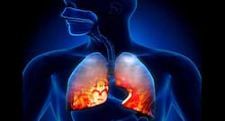 Eat protein rich foods to fight pneumonia