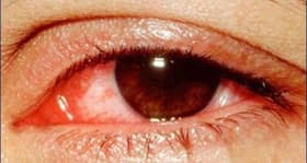 7 suspended after 37 people develop eye infections in MP 7 suspended after 37 people develop eye infections in MP