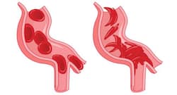 Sickle cell anaemia: This new device can help to reduce infant mortality