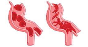 Here’s what every Indian should know about about Sickle Cell Anaemia