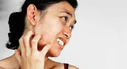 8 highly contagious skin diseases that you should be aware of