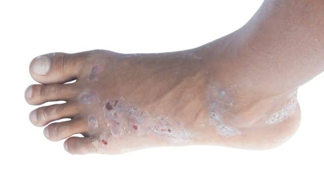 Is your child suffering from hand, foot and mouth disease? Know how to ...