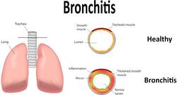 Are you suffering from bronchitis? Follow these home remedies