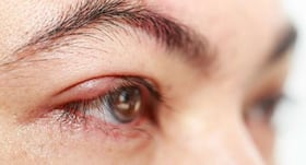 11 expert-reccomended ways to prevent a stye or eye pimple