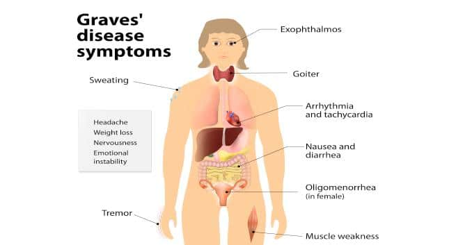 graves-disease-symptoms-graves-disease-treatment-causes-graves