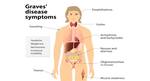Graves disease