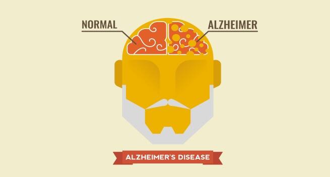 New drug to cut Alzheimer's risk | TheHealthSite.com