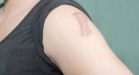 5 things you should never do if you have keloids
