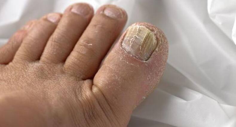 7 signs of candida (yeast) infection you should NEVER ignore