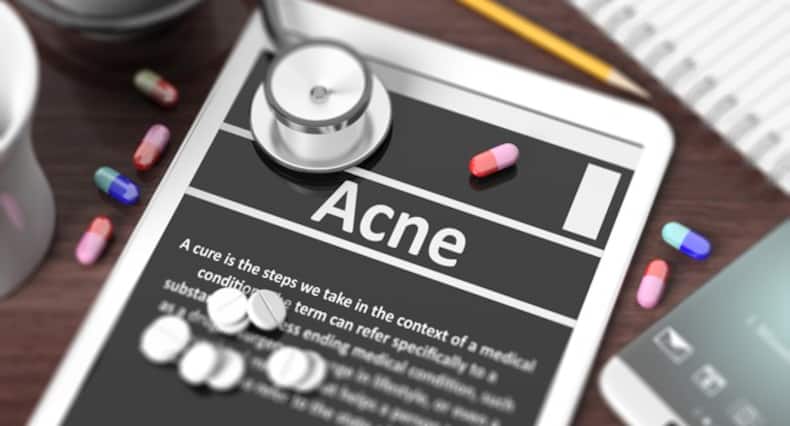 Acne breakout? Don't panic and follow these tips