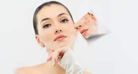 Acne breakout? Don't panic and follow these tips Acne breakout? Don't panic and follow these tips