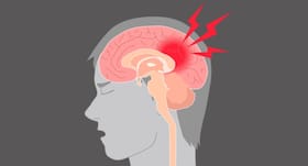 Teens with concussion may benefit from earlier physical therapy (PT)