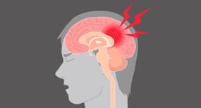 Teens with concussion may benefit from earlier physical therapy (PT)