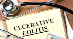 4 herbal remedies for Ulcerative Colitis