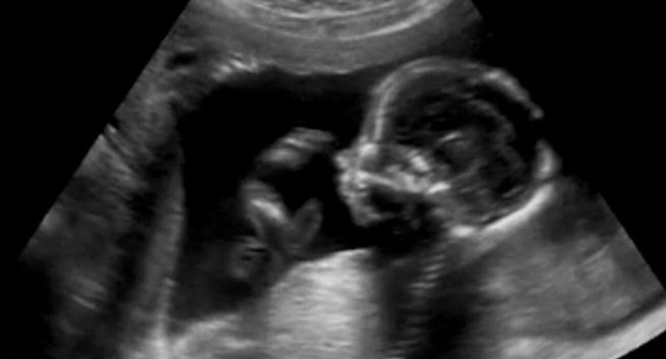 6 complications of gestational diabetes nobody tells you about