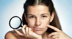 9 shocking causes of acne and what you can do about it