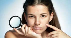 9 shocking causes of acne and what you can do about it