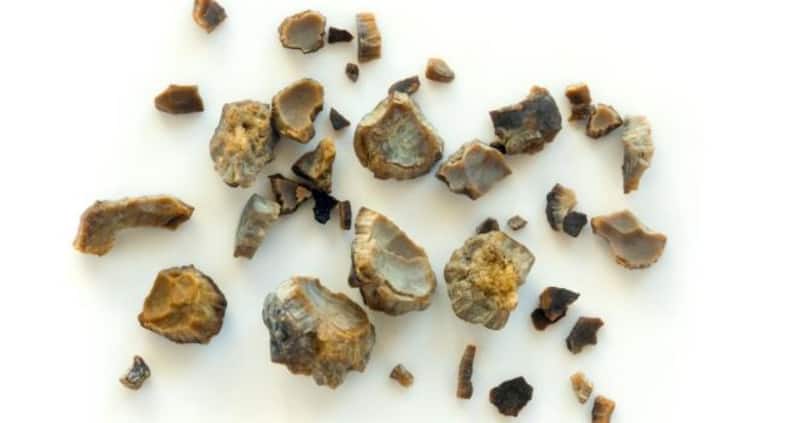 Disturbed sleep, UTI, kidney stones +4 problems of enlarged prostate every man should know