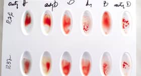 How to read your medical test report: Blood typing and blood cross matching