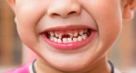 Excess use of toothpaste by kids can cause tooth decay, warns study Excess use of toothpaste by kids can cause tooth decay, warns study