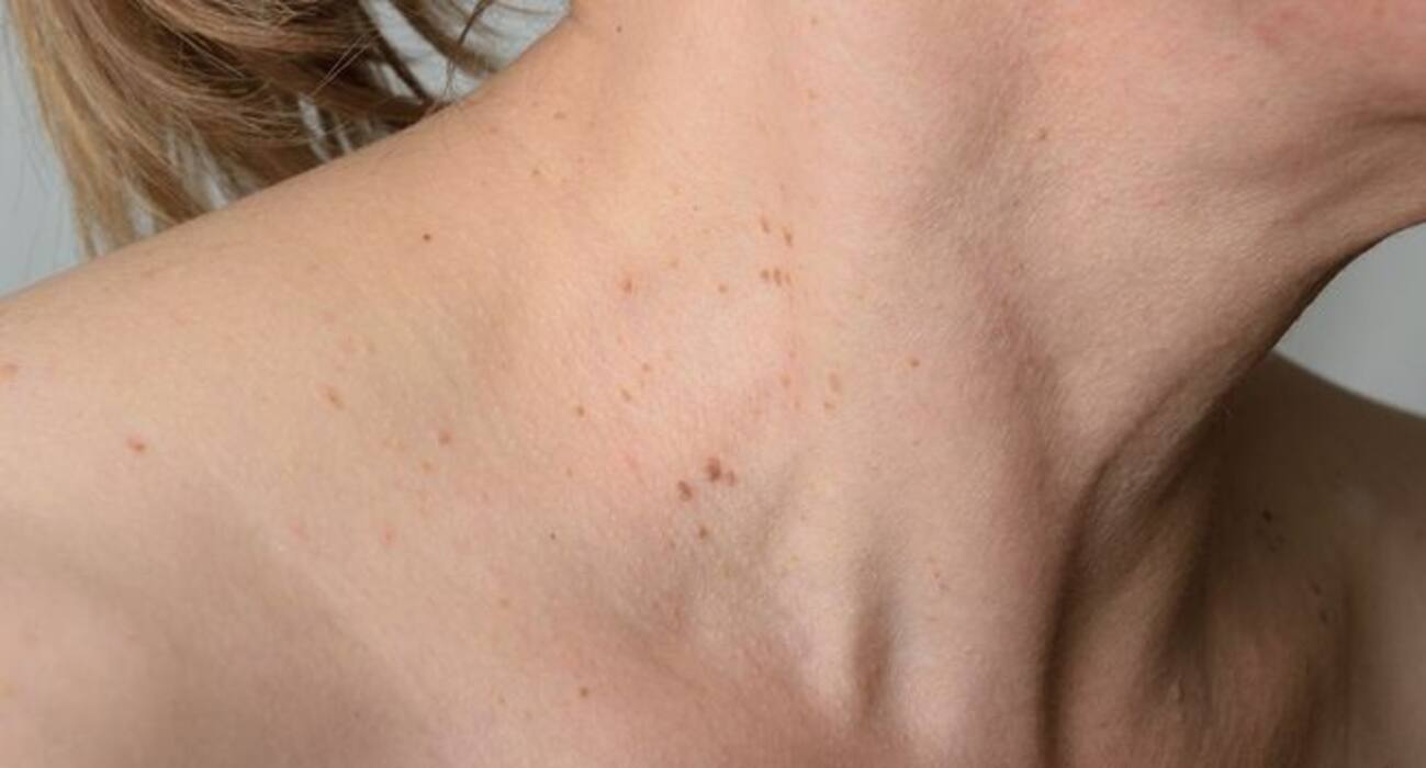 7 types of warts you should be aware of!