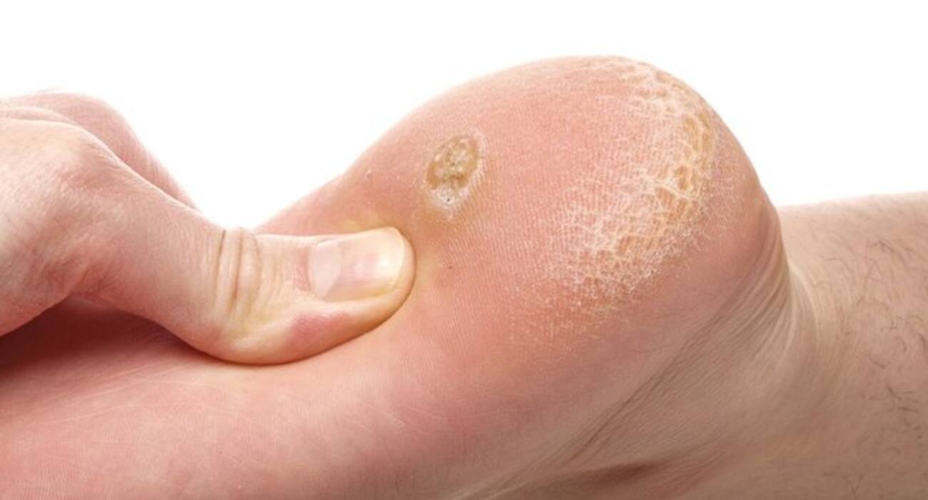 7 types of warts you should be aware of!