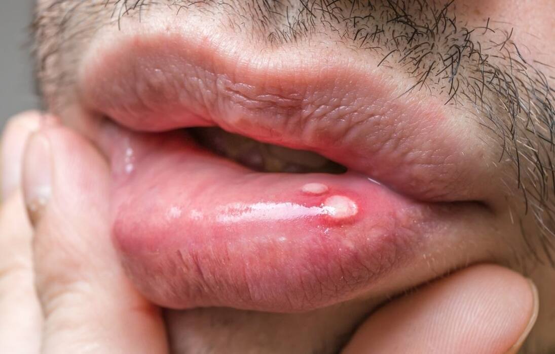 7 types of warts you should be aware of!