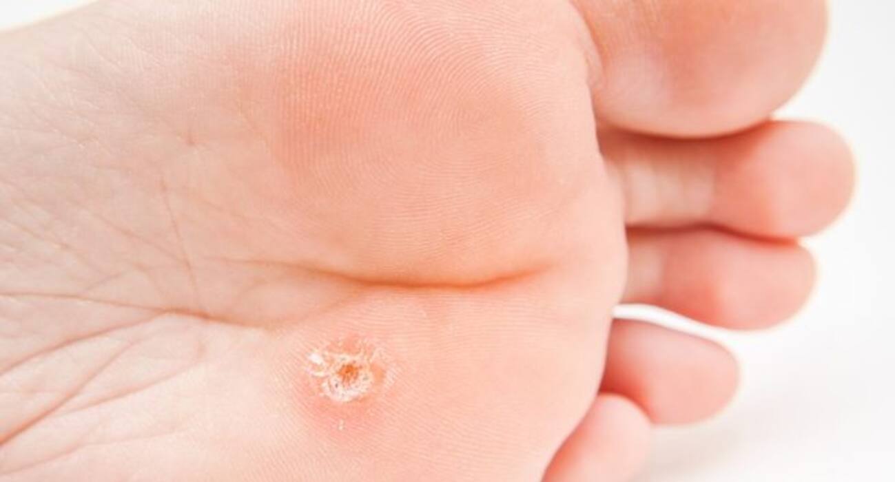 7 types of warts you should be aware of!