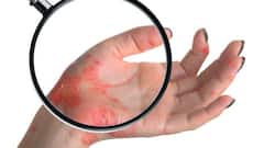 5 foods you should NOT eat if you suffer from psoriasis
