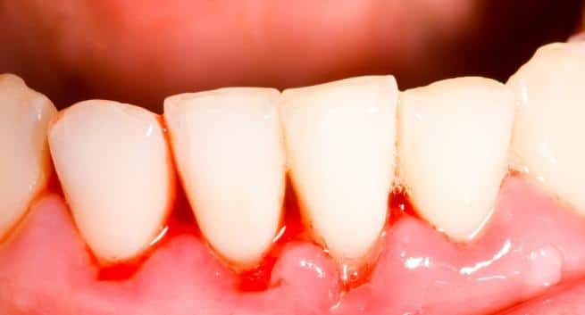 Bleeding gums, bad breath, swollen gums +3 signs of gum disease you ...