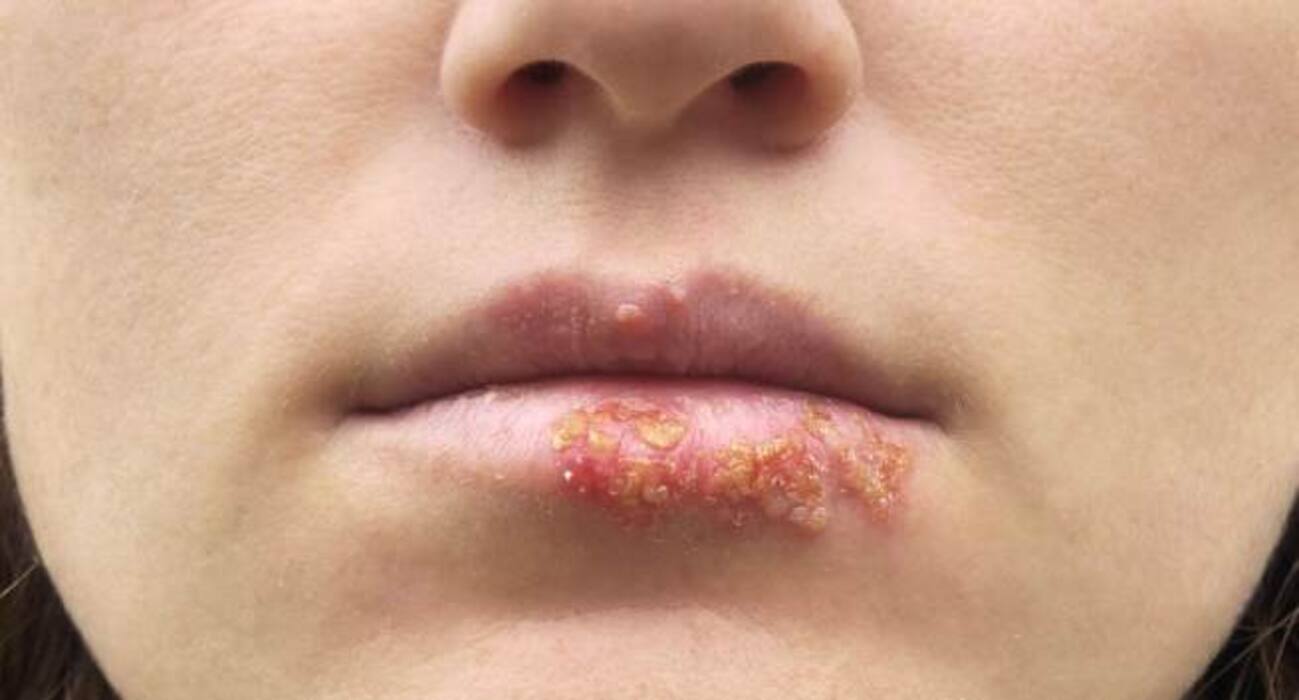 Itching, fever +4 symptoms of genital herpes you should know about