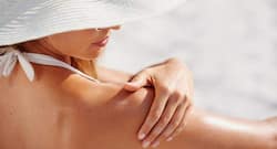 Dairy products will help soothe sunburn