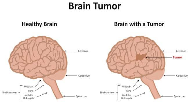 Brain Tumor Diagram