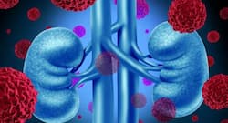 5 facts about kidney cancer you need to know