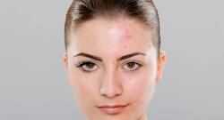 Skincare tip: 6 medications that could be causing your acne