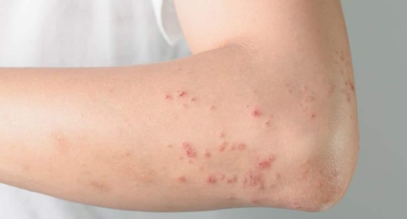 फूड एलर्जी (food allergies) होने के 5 कॉमन लक्षण