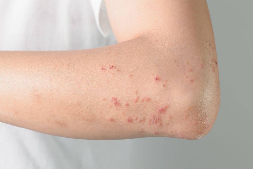 What's a Stress Rash? When Anxiety Triggers Hives - GoodRx
