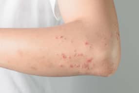 Rain-proof your skin: Watch out for these 4 skin ailments Rain-proof your skin: Watch out for these 4 skin ailments