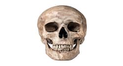 Cribra orbitalia (CO), a skull condition thought to be extinct is still common