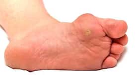 How to deal with corn caps in diabetics? (Query)