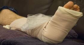 Fracture care: 5 dos and don’ts when you have a cast or splint