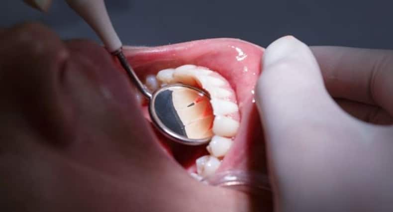 मसूड़ों की बीमारी (gum disease) होने के 6 लक्षण